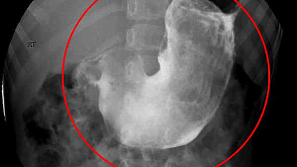 Viral: మహిళకు ఆగకుండా వాంతులు.. టెస్టులు చేయగా.. కడుపులో అడుగు పొడవైన