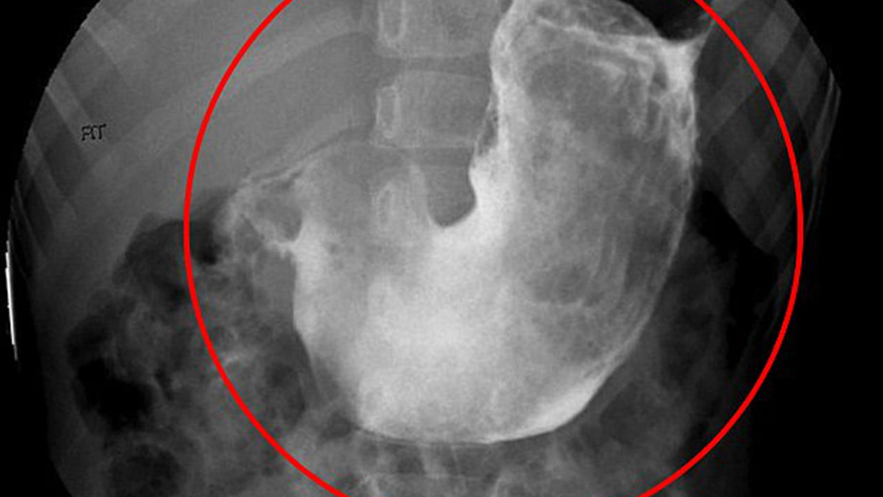 Viral: మహిళకు ఆగకుండా వాంతులు.. టెస్టులు చేయగా.. కడుపులో అడుగు పొడవైన