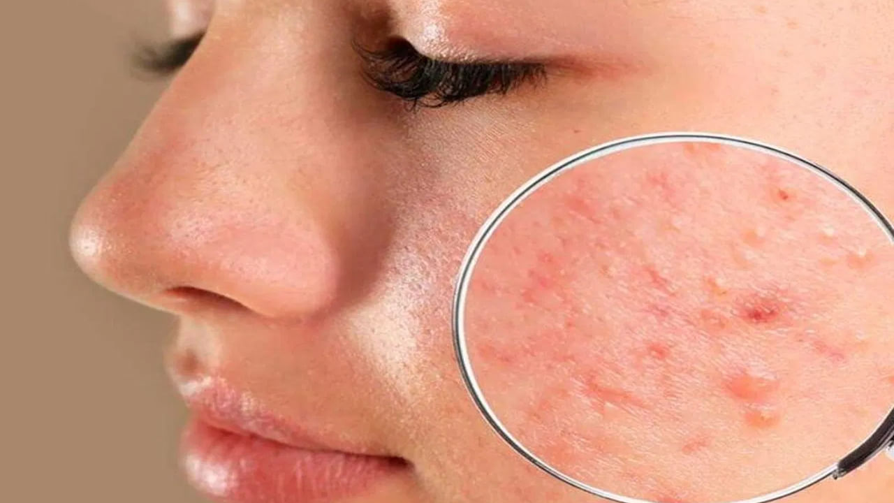 చర్మానికి కారకుడిగా బుధుడిని పరిగణిస్తారు. ఎవరికైనా చర్మం మీద మచ్చలు,  పొట్టు రాలడం, మొటిమలు, చర్మ అలెర్జీలు లేదా ఏదైనా ఇతర చర్మ సంబంధిత సమస్యలతో బాధపడుతుంటే.. దీనికి కారణం జాతకంలో బుధుడు బలహీనంగా ఉండటం కావచ్చు.