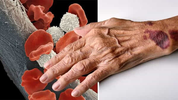 Blood Cancer: ప్రాణాంతక బ్లడ్ క్యాన్సర్కు ముందే చెక్.. కొత్త టెక్నాలజీ కనిపెట్టిన సైంటిస్టులు..