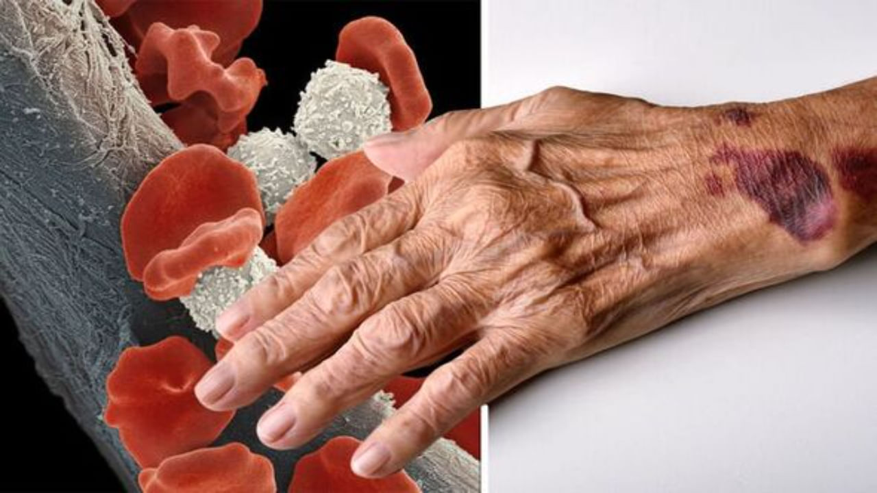 Blood Cancer: ప్రాణాంతక బ్లడ్ క్యాన్సర్కు ముందే చెక్.. కొత్త టెక్నాలజీ కనిపెట్టిన సైంటిస్టులు..