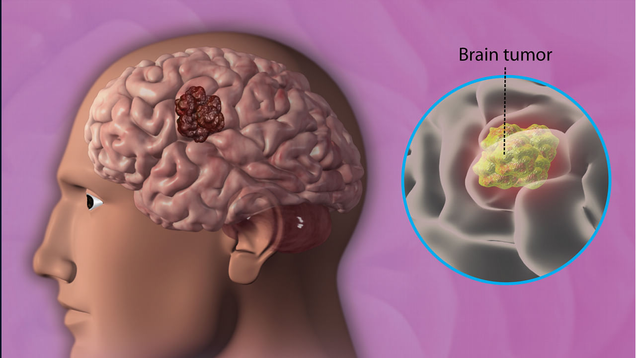 బ్రెయిన్ ట్యూమర్ అనేది ఎక్కువగా వంశపారం పర్యంగా వస్తుందంట. కొన్ని సార్లు వయసుతో సంబంధం లేకుండా ఎవరికైనా వచ్చే ప్రమాదం లేకపోలేదని చెబుతున్నారు నిపుణులు. అంతే కాకుండా ఎక్కువ సేపు రేడియేషన్ ‌కు గురైన వ్యక్తులకు కూడా బ్రెయిన్ ట్యూమర్ వచ్చే ఛాన్స్ ఉంటుందంట.