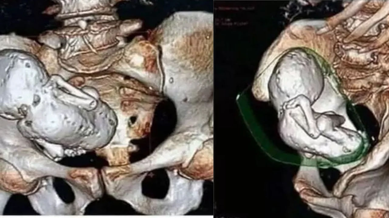 Viral: హెల్త్ చెకప్ కోసం ఆస్పత్రికి 73 ఏళ్ల వృద్ధురాలు - CT స్కాన్ తీసి స్టన్ అయిన వైద్యులు