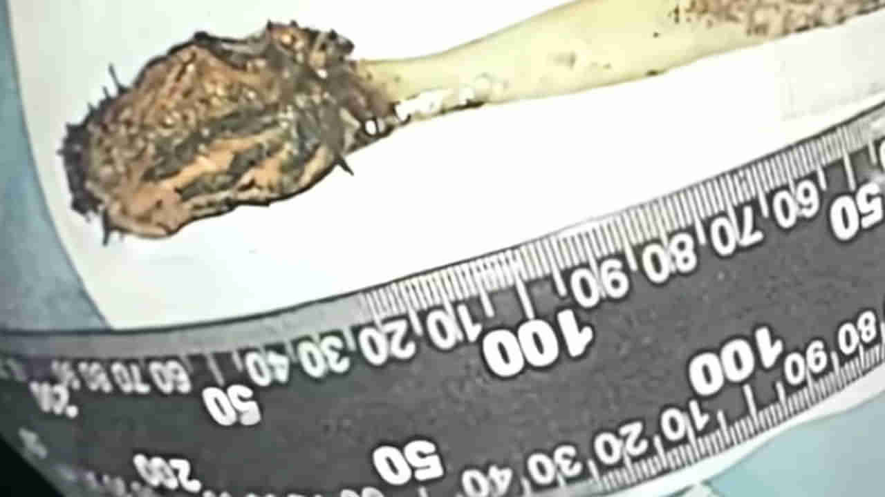 Viral: కడుపులో అదే పనిగా గడబిడ - ఆస్పత్రికి వెళ్లగా CT స్కాన్ తీసిన వైద్యులు షాక్