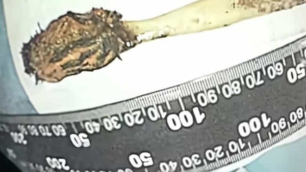 Viral: కడుపులో అదే పనిగా గడబిడ - ఆస్పత్రికి వెళ్లగా CT స్కాన్ తీసిన వైద్యులు షాక్