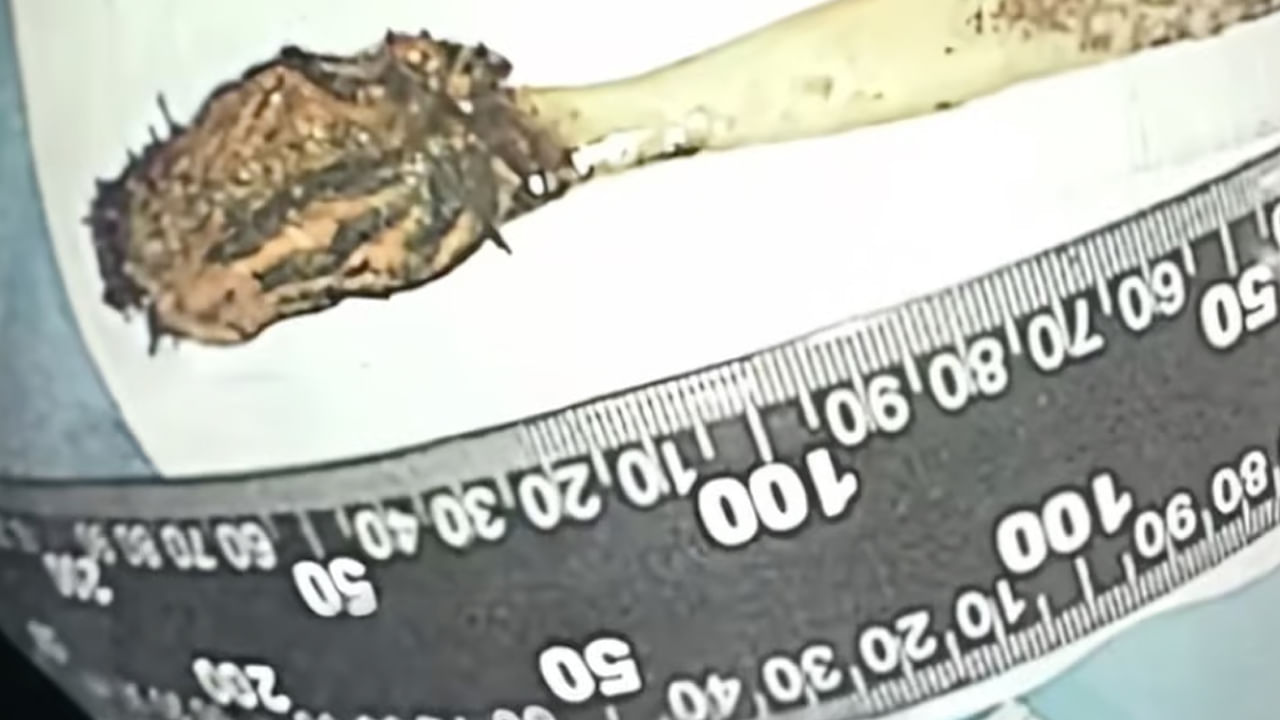 Viral: కడుపులో అదే పనిగా గడబిడ - ఆస్పత్రికి వెళ్లగా CT స్కాన్ తీసిన వైద్యులు షాక్