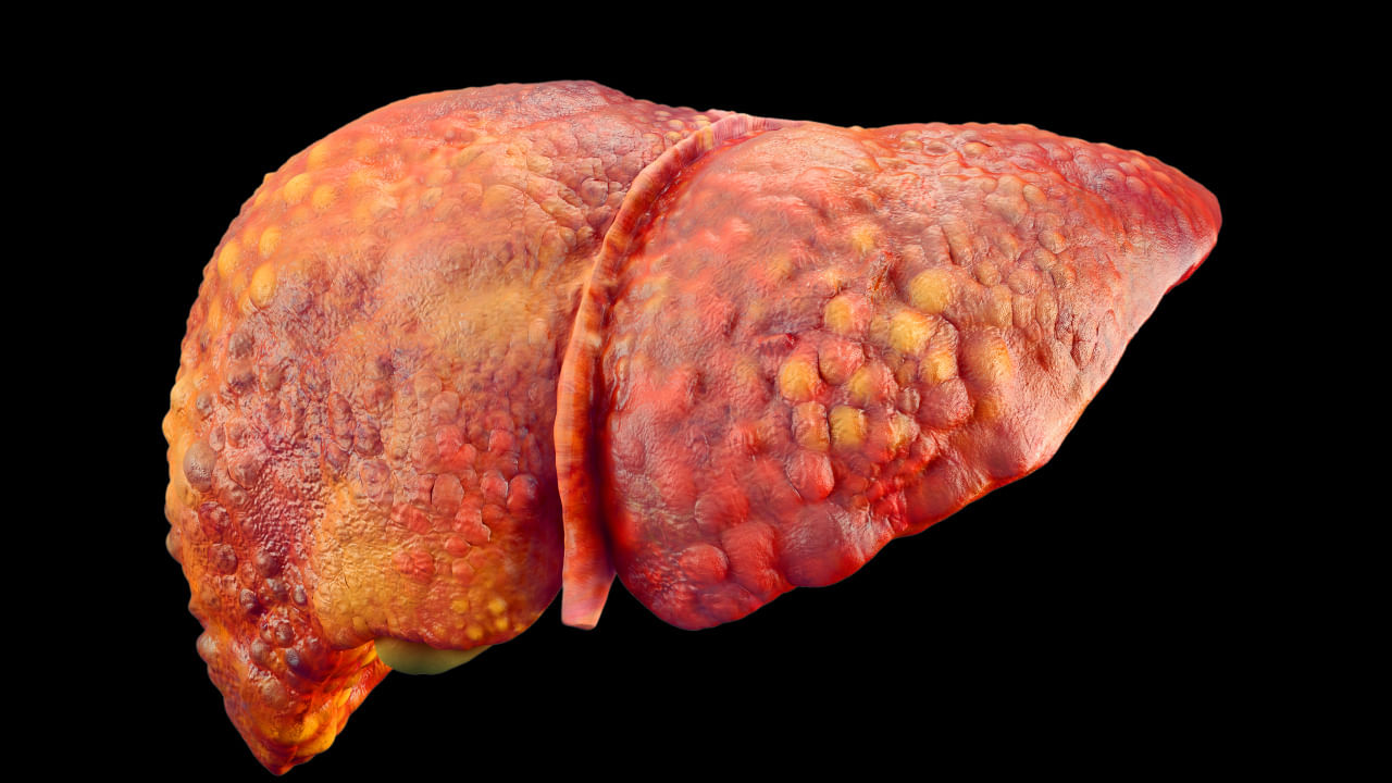 అధిక ఆల్కహాల్ తీసుకోవడం, సరైన ఆహారం తీసుకోకపోవడం, ధూమపానం, ఊబకాయం, వ్యాయామం లేకపోవడం వల్ల ఫ్యాటీ లివర్ సమస్య వస్తుంది. చాలా మందికి టీ తాగడం అంటే ఇష్టం. దానివల్ల కాలేయం కొవ్వుగా మారుతుంది.