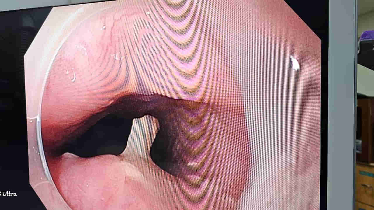 Kakinada: చేపల కూర తింటుండగా ఒక్కసారిగా మహిళకు ఛాతీ, ఉదర భాగంలో నొప్పి.. ఆస్పత్రికి తీసుకెళ్లగా