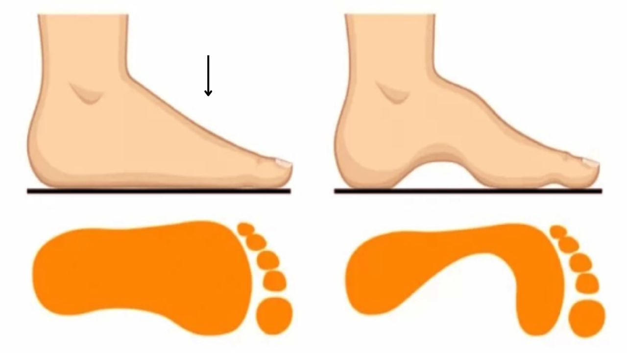 Flat Vs High Arches 1