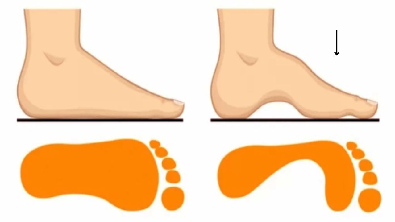 Flat Vs High Arches 2