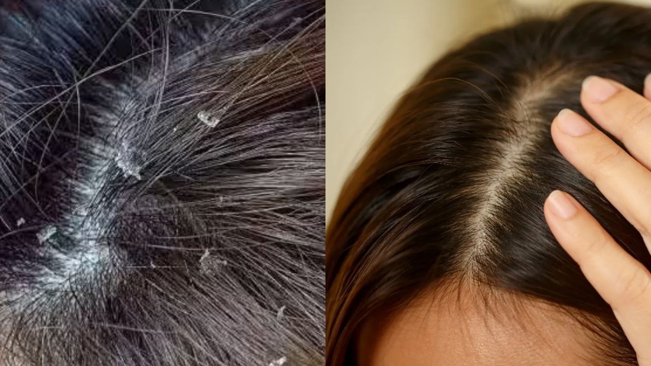 Hair Care: చుండ్రు సమస్యతో ఇబ్బంది పడుతున్నారా..? ఓసారి ఇలా చేయండి.. పక్కా రిజల్ట్ ఉంటుంది..!