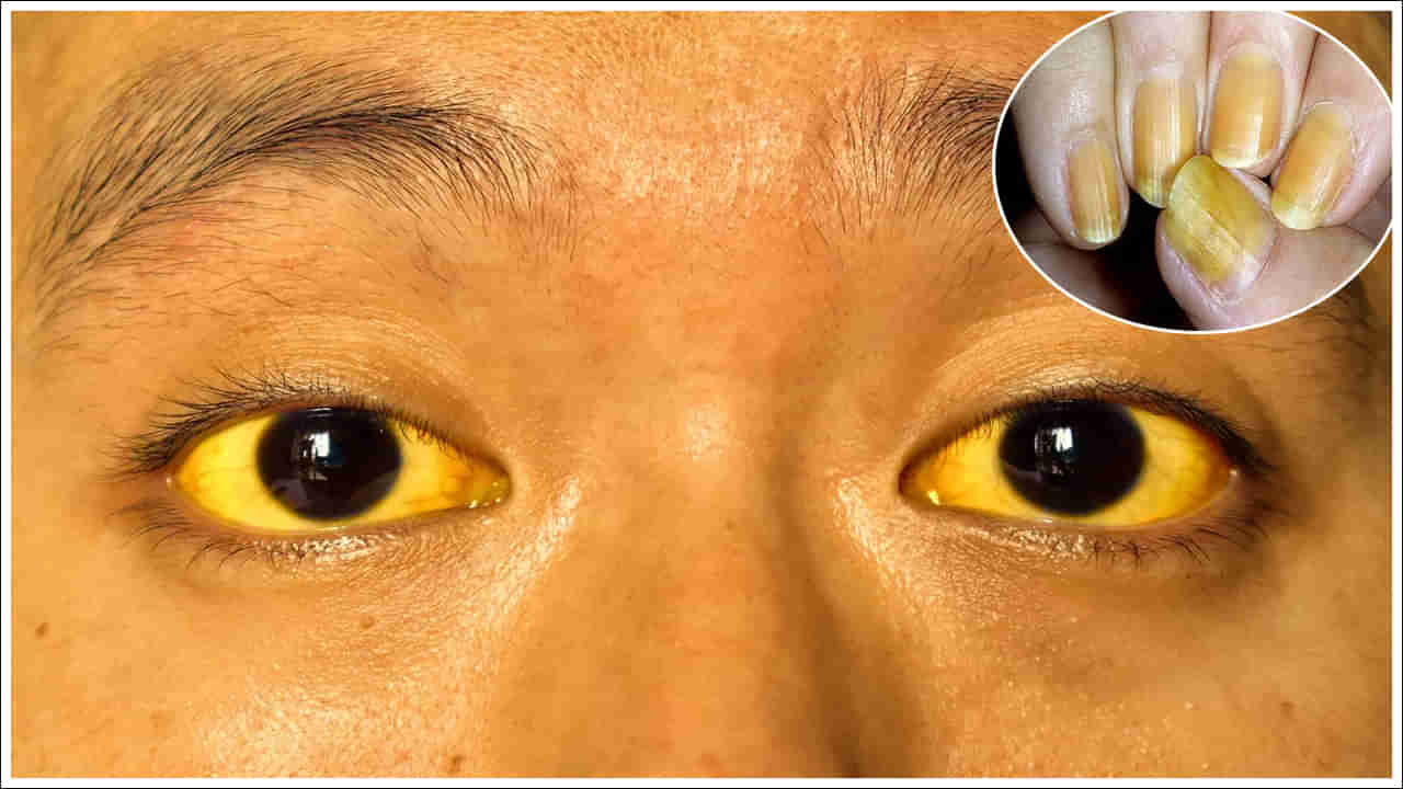 Jaundice: కామెర్లు వచ్చినప్పుడు కళ్ళు, గోర్లు ఎందుకు పసుపు రంగులోకి మారుతాయి? కారణం ఇదే