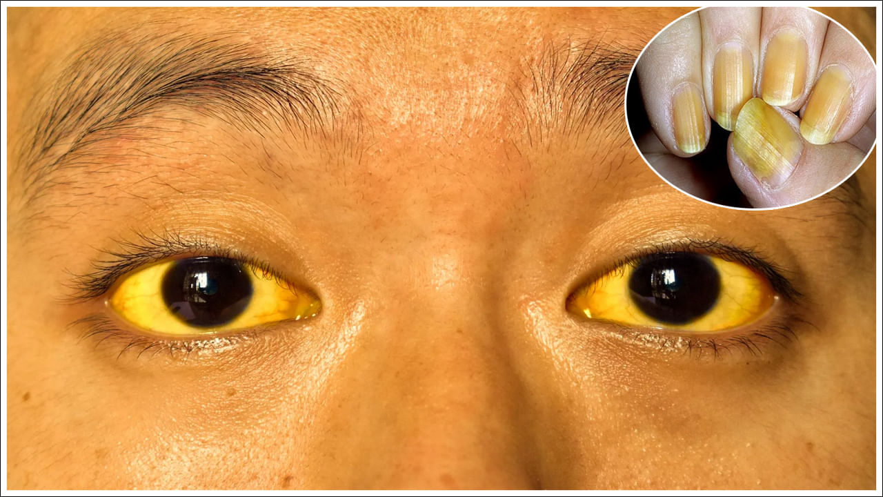Jaundice: కామెర్లు వచ్చినప్పుడు కళ్ళు, గోర్లు ఎందుకు పసుపు రంగులోకి మారుతాయి? కారణం ఇదే