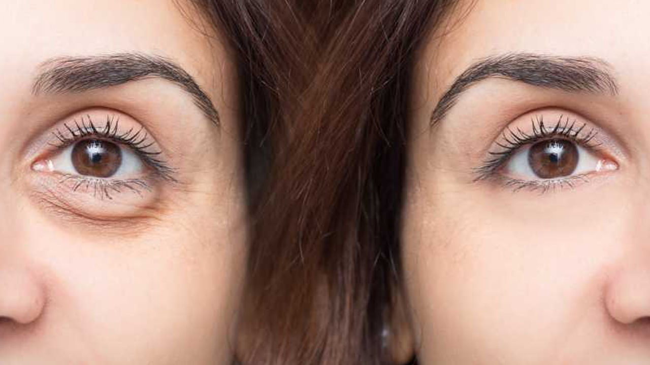 ఉబ్బిన కళ్లు : కళ్లు ఉబ్బడం అనేది కొన్నిసార్లు సహజం. అయితే కంటి నిండా నిద్రపోయినా, కళ్లు ఉబ్బినట్లు అనిపిస్తే.. రోజుల తరబడి ఇలానే జరిగితే కాస్త  జాగ్రత్తపడాలి అంటున్నారు ఆరోగ్య నిపుణులు. ఎందుకంటే. కొన్ని సార్లు మూత్రపిండాలు దెబ్బతింటే కూడా కళ్లు ఉబ్బినట్లు కనిపిస్తాయంట. దీనిని ప్రోటీన్యూరియా అంటారంట. అందుకే ఈ విషయంలో కాస్త జాగ్రత్త అవసరం.