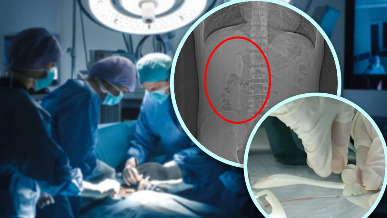 Viral: కడుపులో అసౌకర్యంగా ఉందని ఆస్పత్రికి యువకుడు – స్కానింగ్ తీసి రిపోర్ట్ చూడగా స్టన్