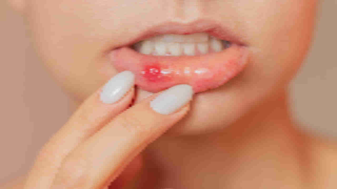 Mouth Ulcers: నోటి అల్సర్లు ఈ ప్రాంతాల్లోనే ఎందుకొస్తాయి?.. ఈ లోపమే కారణం!