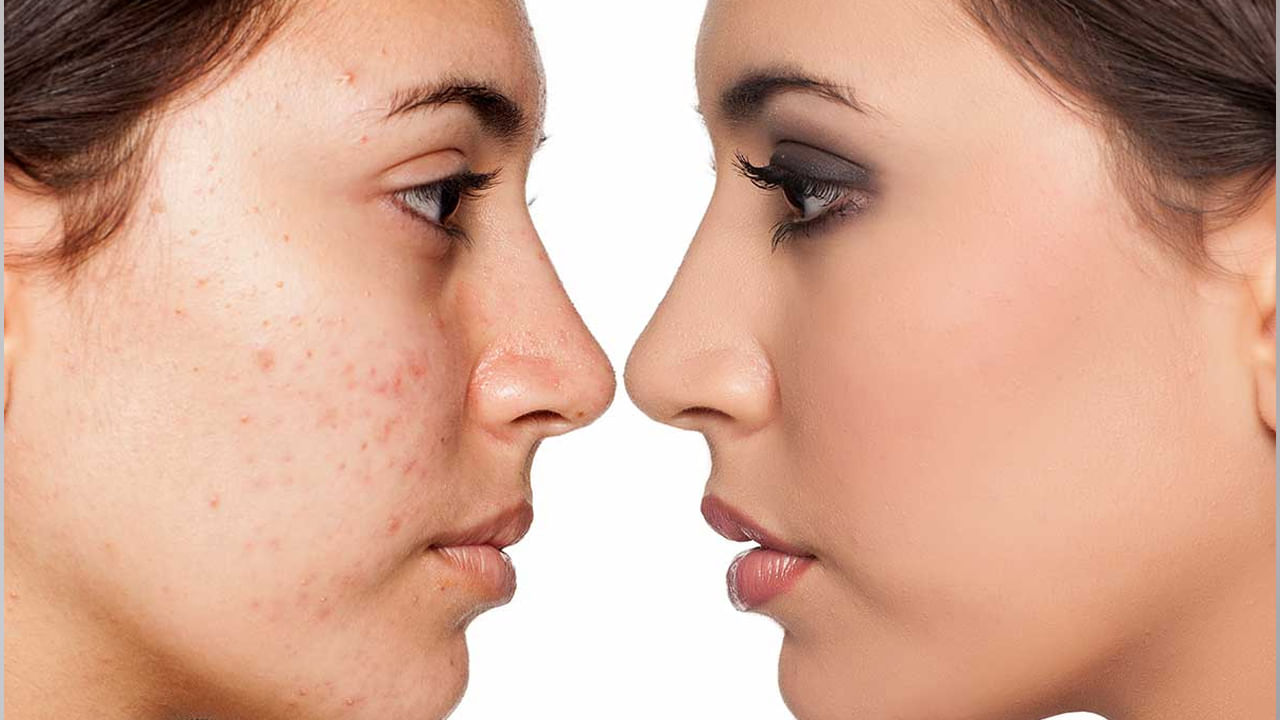 Pimples