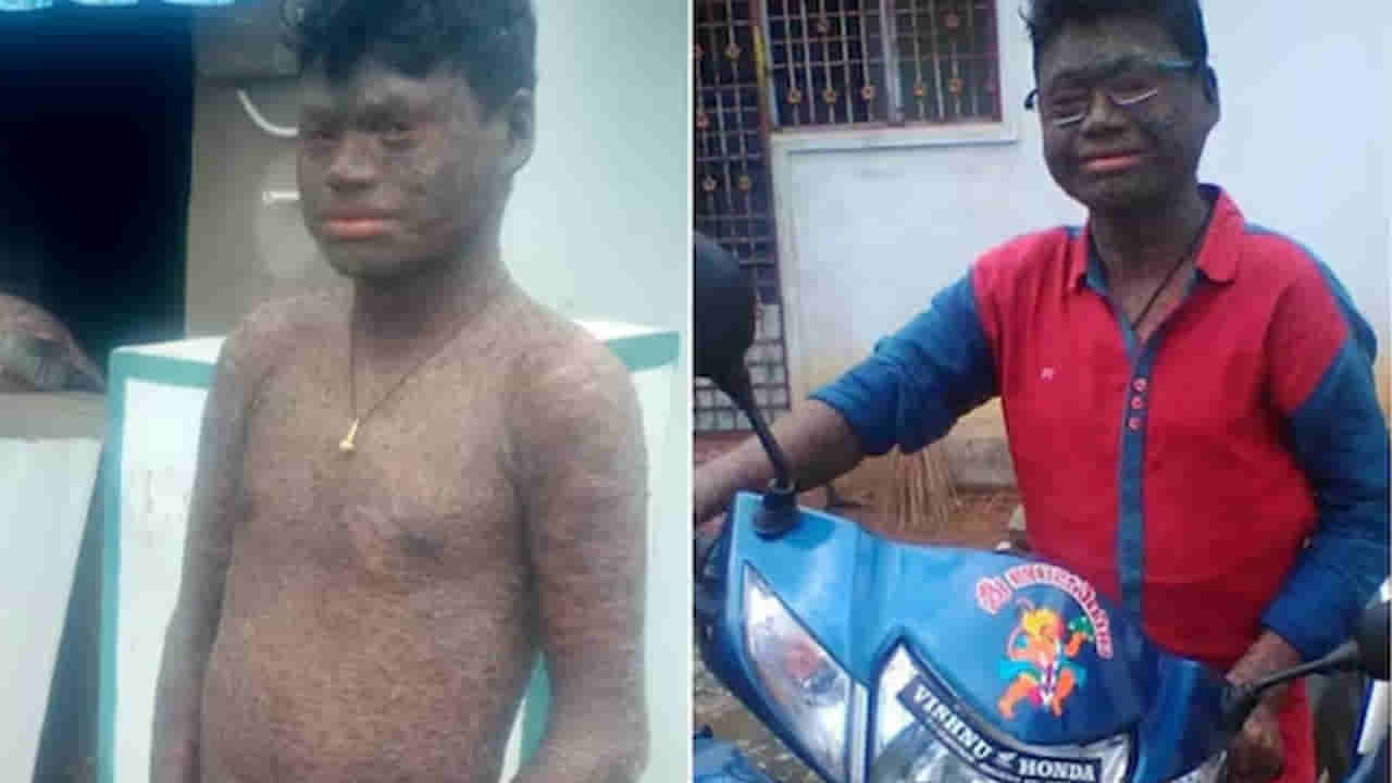 Andhra: అమ్మ బాబాయ్.. పాము మాదిరిగా అతని చర్మం రోజూ ఊడిపోతుంది..