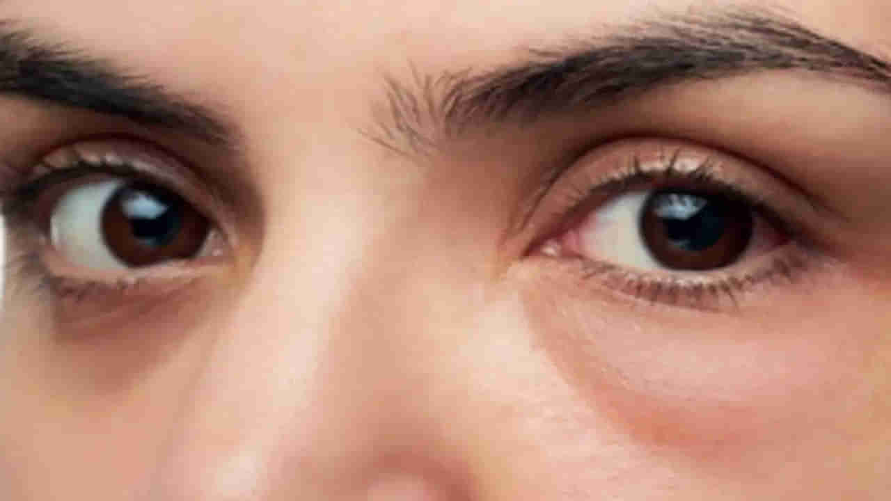 కళ్లు ఉబ్బి ఇలాంటి లక్షణాలు కనిపిస్తున్నాయా..? యమ డేంజర్.. మీ కిడ్నీలు షెడ్డుకెళ్తున్నట్లే