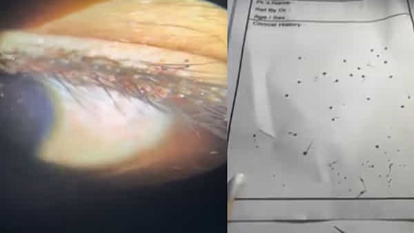 Viral News: 8 ఏళ్ల బాలుడికి ఎంతకూ తగ్గని కంటి నొప్పి.. పరుగున ఆస్పత్రికి తీసుకెళ్లగా..