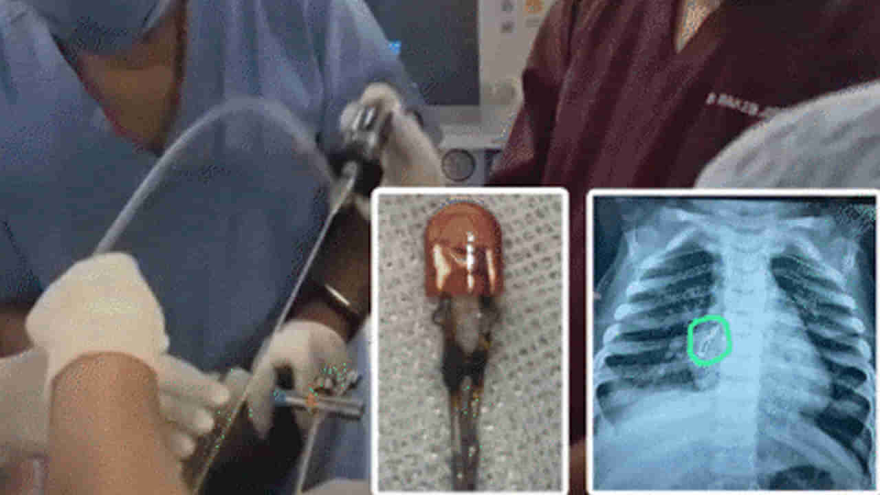 Viral: 9 నెలల బాలుడికి ఎన్ని మెడిసిన్ వాడినా దగ్గు తగ్గట్లే.. ఆస్పత్రిలో ఎక్స్ రే తీయించగా