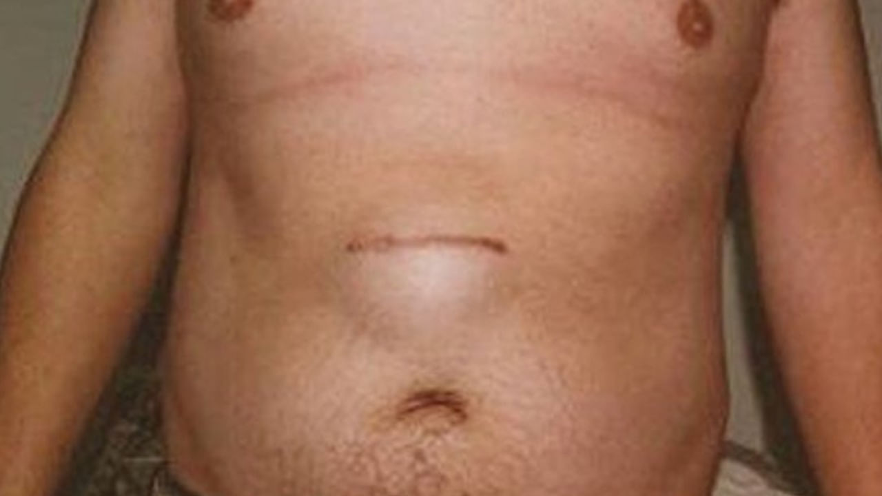 పొత్తికడుపులో గడ్డ: పొత్తికడుపులో కనిపించే గడ్డ పిత్తాశయ క్యాన్సర్‌కు హెచ్చరిక సంకేతం కావచ్చు. పిత్తాశయం ఉబ్బి పెద్దదిగా మారినప్పుడు, పిత్త వాహిక పిత్తంతో నిండిపోవడం వల్ల లేదా క్యాన్సర్ కాలేయం యొక్క సమీప భాగాలకు వ్యాపించినప్పుడు ఇది సాధారణంగా సంభవిస్తుంది. అల్ట్రాసౌండ్ వంటి ఇమేజింగ్ పరీక్షల ద్వారా కూడా ఈ గడ్డను గుర్తించవచ్చు.