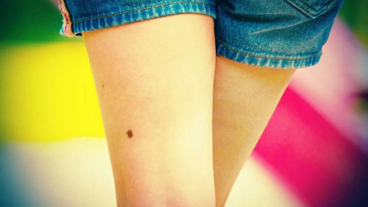 మోకాలిపై పుట్టు మచ్చ ఉంటే ఏంటి లాభం? సాముద్రిక శాస్త్రం ఏం చెబుతోంది..?