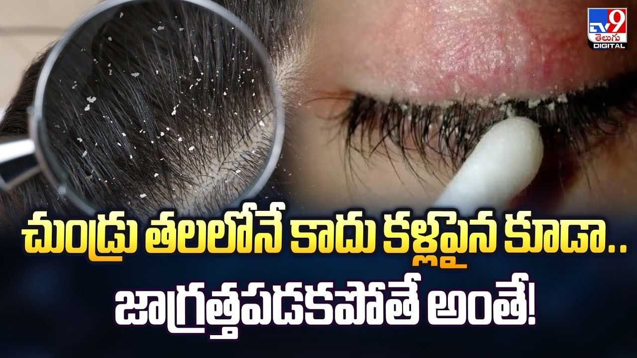 చుండ్రు తలలోనే కాదు కళ్లపైన కూడా.. జాగ్రత్తపడకపోతే అంతే! చుండ్రు తలలోనే కాదు కళ్లపైన కూడా.. జాగ్రత్తపడకపోతే అంతే!