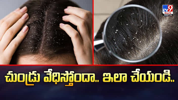 చుండ్రు వేధిస్తోందా.. ఇలా చేయండి చుండ్రు వేధిస్తోందా.. ఇలా చేయండి