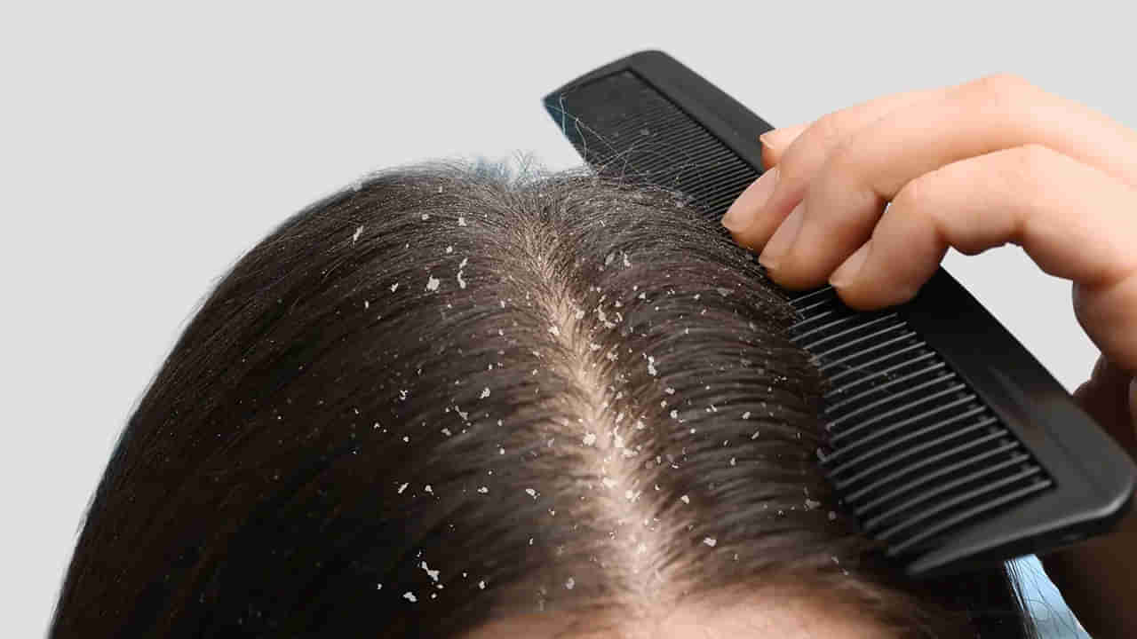 Dandruff: వర్షాకాలంలో చుండ్రును తరిమికొట్టే పవర్‌ఫుల్ చిట్కా.. వారానికి 2 సార్లు చేస్తే సరి!