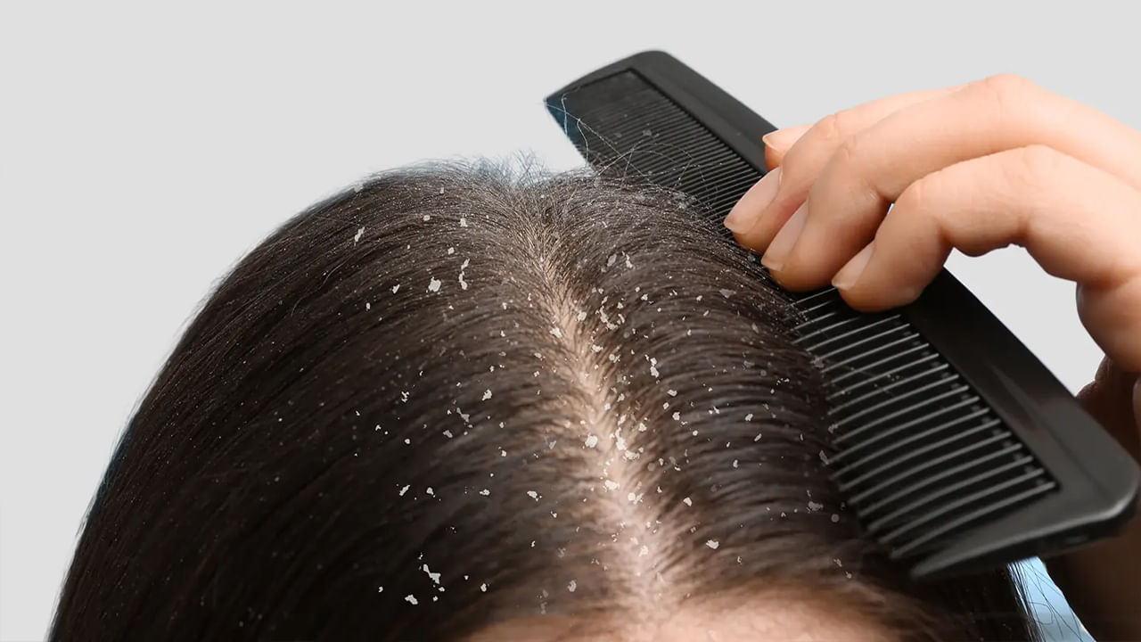 Dandruff: వర్షాకాలంలో చుండ్రును తరిమికొట్టే పవర్ఫుల్ చిట్కా.. వారానికి 2 సార్లు చేస్తే సరి!