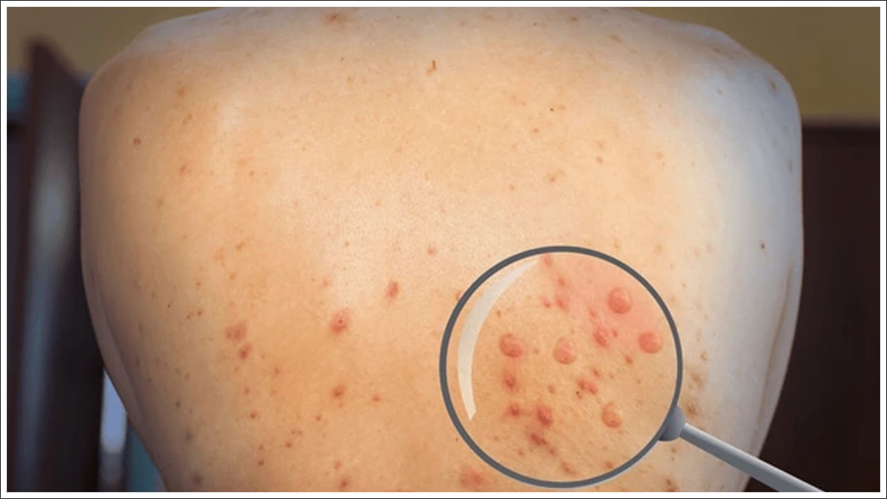 చర్మంపై ఎర్రటి దద్దుర్లు, ప్లేట్లెట్లు పడిపోవడం: డెంగ్యూ మూడవ అతి ముఖ్యమైన లక్షణం చర్మంపై ఎర్రటి దద్దుర్లు, శరీరంలో ప్లేట్లెట్ల సంఖ్య వేగంగా తగ్గడం. సాధారణంగా డెంగ్యూ జ్వరం తర్వాత 3 నుండి 4 రోజుల తర్వాత చర్మంపై దద్దుర్లు కనిపించడం ప్రారంభిస్తాయి. దీనితో పాటు ముక్కు, చిగుళ్ళు లేదా మూత్రంలో కూడా రక్తస్రావం సంభవించవచ్చు. ప్లేట్లెట్ల తగ్గుదల డెంగ్యూ అత్యంత ప్రమాదకరమైన దశగా పరిగణిస్తారు. ఇది రక్తస్రావంకు దారితీస్తుంది. ఆసుపత్రిలో చేరడానికి దారితీస్తుంది.