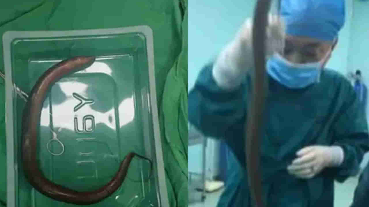 Viral: భరించలేని కడుపు నొప్పి అంటూ ఆస్పత్రిక వచ్చిన వ్యక్తి - CT స్కాన్ తీసిన వైద్యులు షాక్