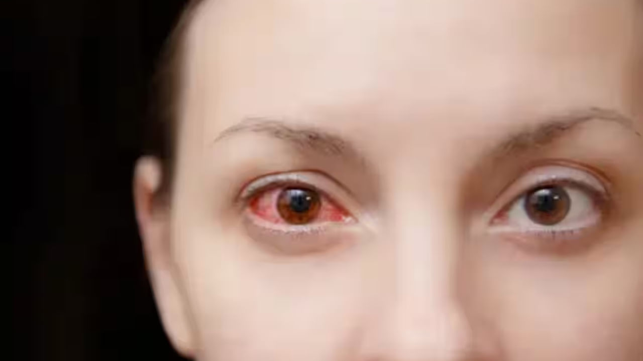 కంటి ఫ్లూ అనేది కాలానుగుణంగా, వార్షికంగా వచ్చే వ్యాధి. ఒకసారి సోకిన తర్వాత, రెండు కళ్ళు ఎర్రగా మారడం (సాధారణంగా ఒక్కొక్కటిగా), అధికంగా నీరు కారడం. మందపాటి, జిగటగా స్రావం వంటి లక్షణాలు త్వరగా అభివృద్ధి చెందుతాయి. రోగులు గ్రౌట్ లాంటి అనుభూతి, రక్తస్రావం, కనురెప్పల వాపును అనుభవించవచ్చు. భారతదేశంలో సోకిన వారిలో ఎక్కువ మంది కార్నియాను ప్రభావితం చేసే తీవ్రమైన కేసులు దృష్టిని దెబ్బతీస్తాయి.