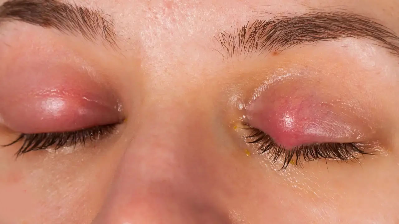 కార్టికోస్టెరాయిడ్స్ వాపు తగ్గడాన్ని వేగవంతం చేస్తాయి. కానీ నేత్ర వైద్యుడి పర్యవేక్షణలో వాడాలి. ముఖ్యంగా, హెర్పెస్ సంబంధిత కంటి ఇన్ఫెక్షన్లలో స్టెరాయిడ్ల పర్యవేక్షణ లేకుండా వాడటం వల్ల ఇలాంటి లక్షణాలు ఏర్పడతాయి, ఇది అంధత్వంతో సహా తీవ్రమైన సమస్యలకు దారితీస్తుంది. అవగాహన, సరళమైన పరిశుభ్రత పద్ధతులతో, ముఖ్యంగా చేతులు కడుక్కోవడం మరియు కళ్ళు తాకకుండా ఉండటం ద్వారా, కంటి ఫ్లూ పూర్తిగా నివారించవచ్చు. దాని వ్యాప్తిని ఆపడానికి కీలకం మీ చేతుల్లోనే ఉంది - వాటిని తరచుగా కడుక్కోండి.