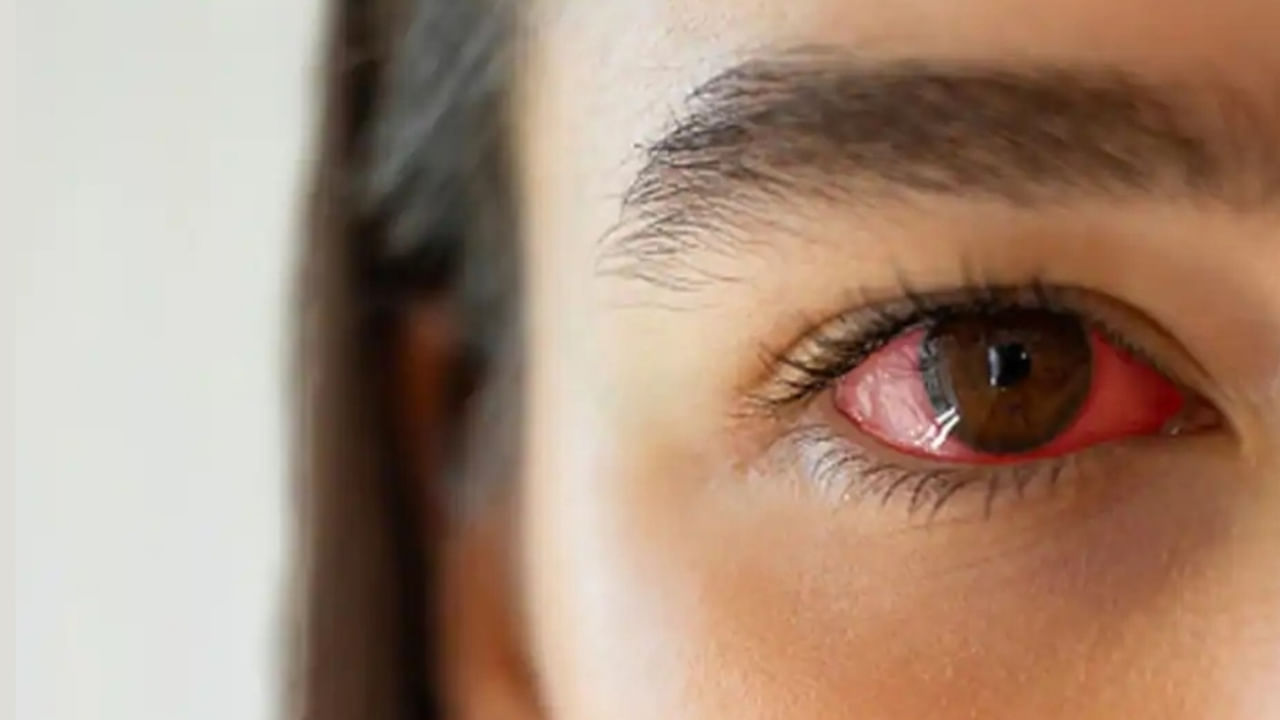 కంటి ఫ్లూ వ్యాప్తి తరచుగా కంటి క్లినిక్‌లు వంటి బహిరంగ ప్రదేశాలలో ప్రారంభమవుతుంది. ఇక్కడ కలుషితమైన ఉపరితలాలు వైరస్‌ను త్వరగా వ్యాపింపజేస్తాయి. అంటువ్యాధి సమయంలో అన్ని వస్తువులను కలుషితమైనవిగా పరిగణించాలి. పాఠశాలలు, ఆసుపత్రులు, స్విమ్మింగ్ పూల్స్, కార్యాలయాలు, థియేటర్లు, ఇంట్లో ఉన్న కుటుంబాలు వంటి ఇతర సన్నిహిత-సంబంధిత ప్రదేశాలు కూడా వ్యాప్తికి గురవుతాయి.