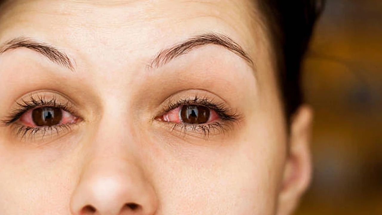 దీని వ్యాప్తిని నివారించడానికి, ముఖ్యంగా కంటి ఆసుపత్రులు లేదా క్లినిక్‌లలో తరచుగా తాకే ఉపరితలాలను బ్లీచ్‌తో క్రిమిరహితం చేయాలి. సోకిన వ్యక్తులు, ముఖ్యంగా పాఠశాల పిల్లలు, కార్యాలయ ఉద్యోగులు, ఎరుపు తగ్గే వరకు ఒంటరిగా ఉండాలి. లక్షణాలు కనిపించకుండా పోయిన తర్వాత కూడా, కన్నీళ్లలో, చేతుల్లో మిగిలి ఉన్న అవశేష వైరస్ ఇప్పటికీ సంక్రమణను వ్యాప్తి చేస్తుంది.