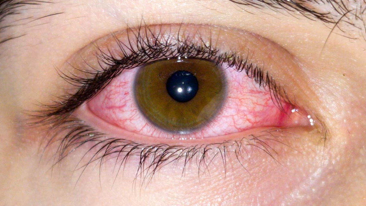 100 కంటే ఎక్కువ విభిన్న AdV రకాలు ఉన్నాయి, కానీ అత్యంత తీవ్రమైన వాటిలో ఒకటైన D-8 రకం భారతదేశంలో సాధారణం. AdV కండ్లకలకకు నిర్దిష్ట యాంటీవైరల్ చికిత్స లేదు, ఎందుకంటే ఇది సాధారణంగా స్వీయ-పరిమితం చేస్తుంది. లక్షణాలను తగ్గించడానికి కొన్నిసార్లు సమయోచిత యాంటీబయాటిక్‌లను ఉపయోగించినప్పటికీ, అవి ఎల్లప్పుడూ అవసరం లేదు. కృత్రిమ కన్నీటి కంటి చుక్కలు అసౌకర్యాన్ని తగ్గిస్తాయి మరియు క్లినిక్‌లలో పోవిడోన్-అయోడిన్ క్రిమినాశక కంటి వాష్‌లు సంక్రమణను తగ్గించవచ్చు.