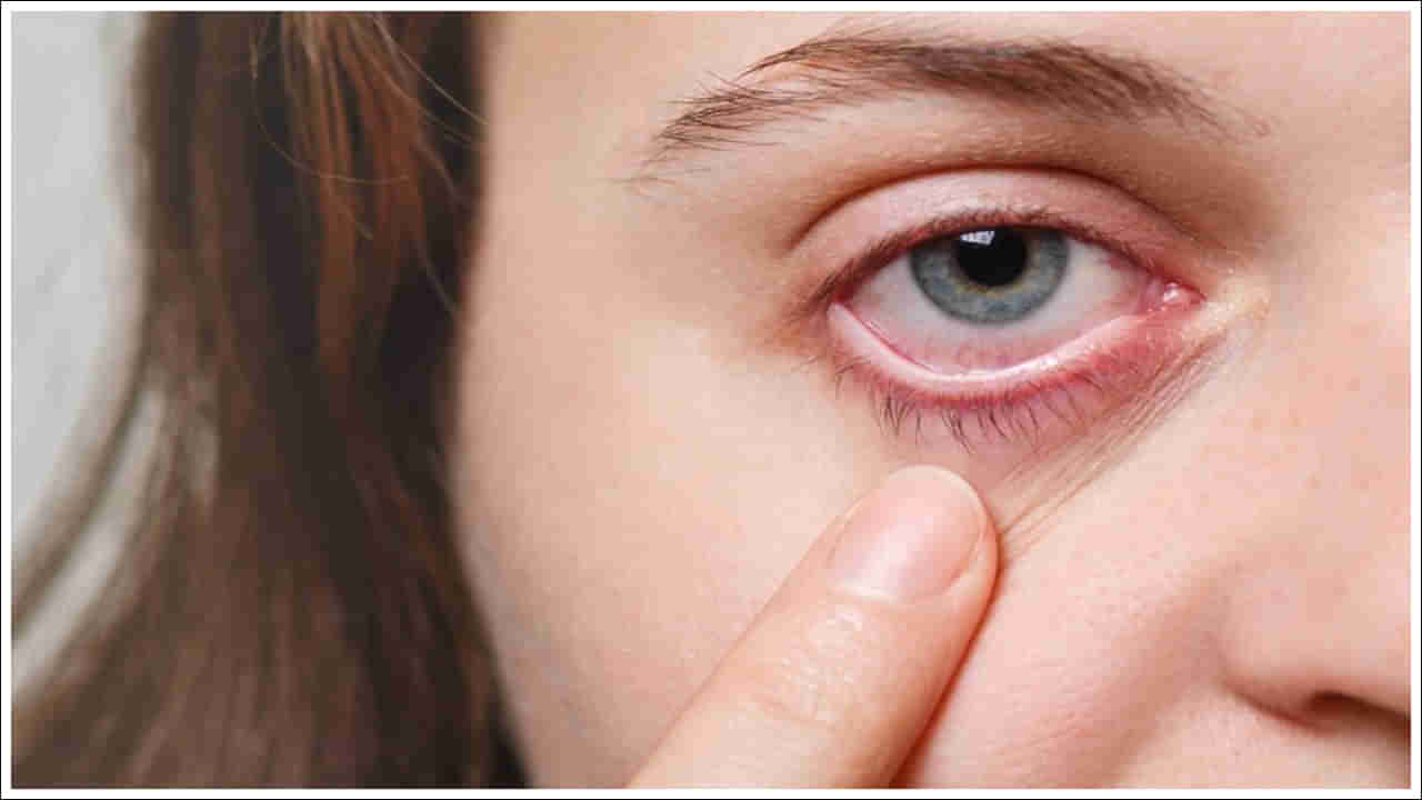 Eyes Tips: మీ కళ్లు ఎర్రగా మారుతున్నాయా? కారణం ఏంటి? ఇలా చేయండి!