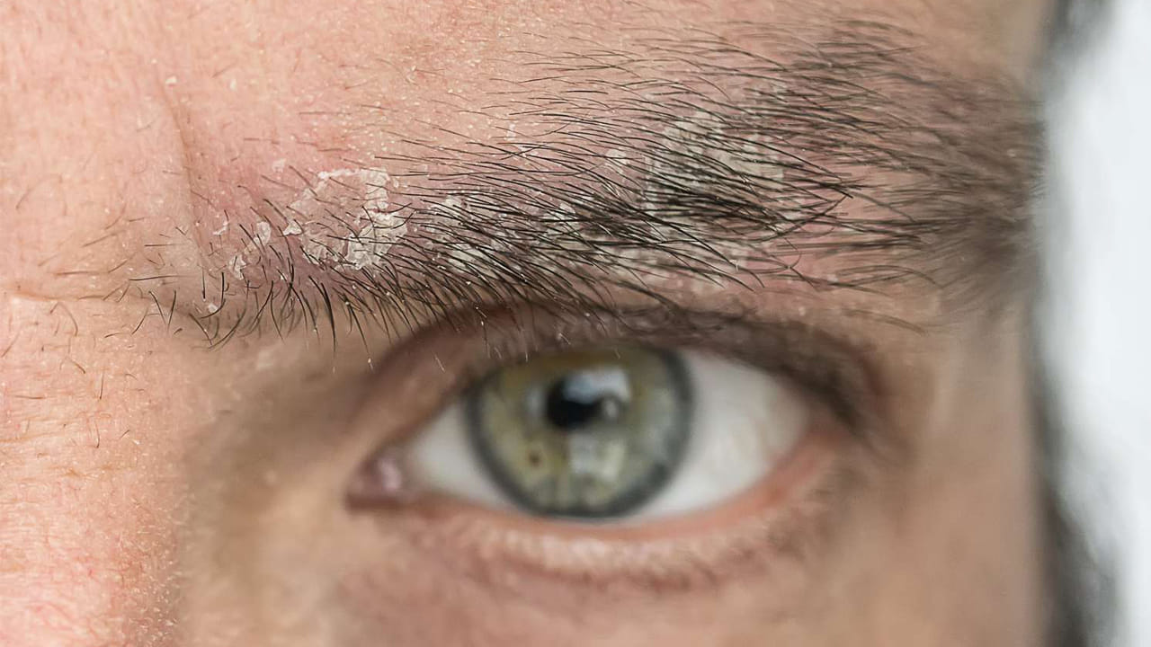 చుండ్రు అంటే చాలు అందరికీ ముందుగా గుర్తు వచ్చేది  తల.  కానీ తలపైనే కాదండో కను రెప్పలపై కూడా చుండ్రు వస్తుంది. ఇది చాలా ప్రమాదకరం అని చెబుతున్నారు ఆరోగ్య నిపుణులు. కను రెప్పలపై ఉండే చుండ్రు ఎక్కువగా కనిపించదంట. కానీ దీని ప్రభావం మాత్రం కళ్లపై తీవ్ర స్థాయిలో ఉంటుందని హెచ్చరిస్తున్నారు వైద్యులు. కాగా, కనురెప్పలపై చుండ్రు ఉంటే ఎలాంటి లక్షణాలు కనిపిస్తాయో ఇప్పుడు చూద్దాం.