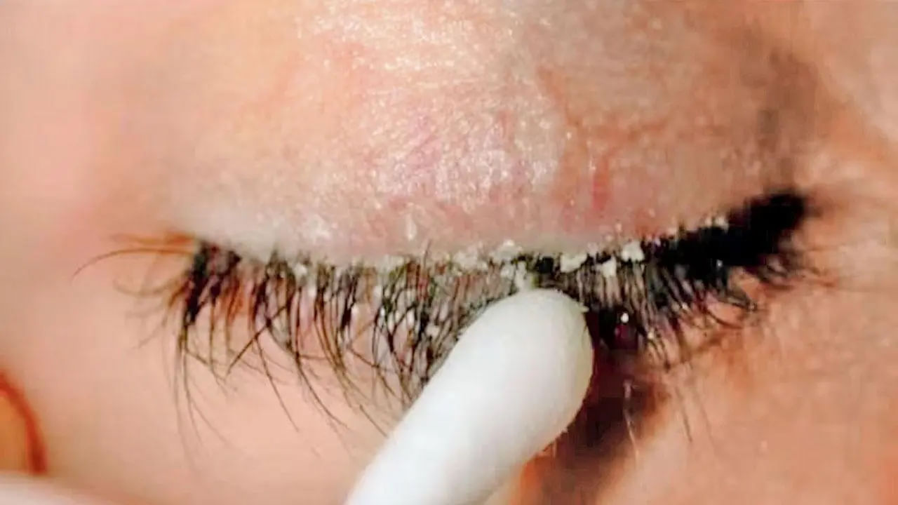 ఇలాంటి లక్షణాలు కనిపించినప్పుడు కళ్లపై ప్రత్యేక శ్రద్ధ తీసుకోవాలంట. రోజూ గోరు వెచ్చటి నీటిలో తడి గుడ్డ వేసి రోజుకు కనీసం ఐదు నుంచి పది నిమిషాల పాటు కాట్ క్లాత్‌తో కళ్లను శుభ్ర పరుచుకోవాలంట. దీని వలన కనురెప్పలపై చుండ్రు సమస్య నుంచి కాస్త ఉపశమనం కలుగుతుందంట. ఒక వేళ ఈ కనురెప్పలపై చుండ్రు సమస్య తీవ్రతరం అవుతే ఇది కళ్లపై తీవ్ర ప్రభావం చూపుతుందంట.