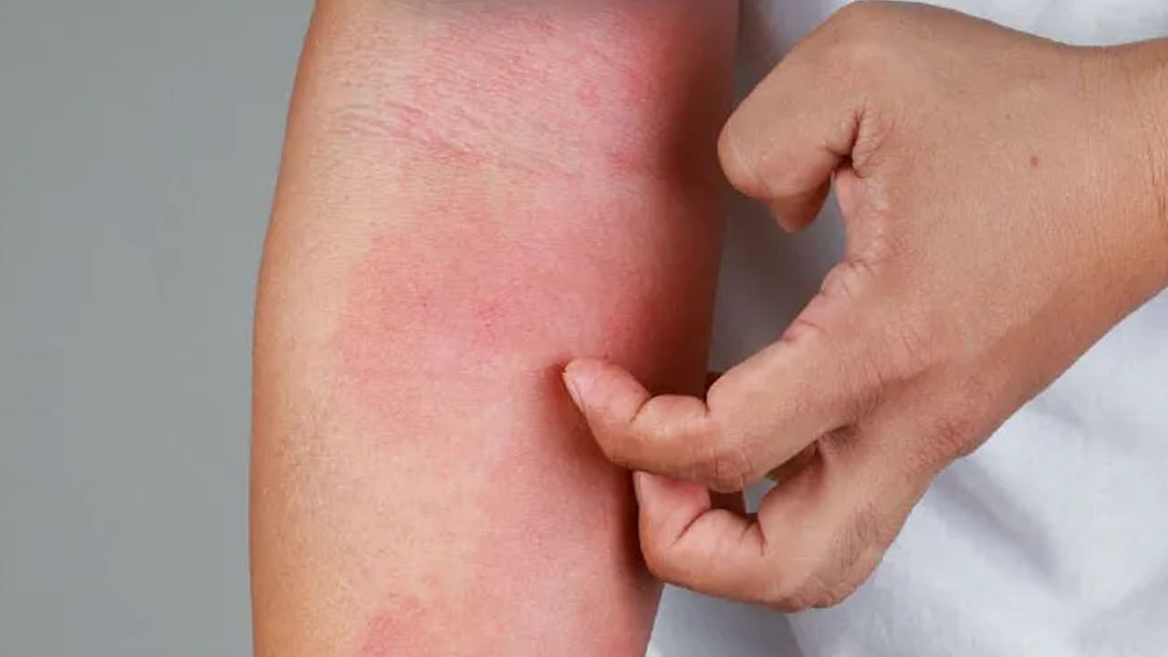 నిరంతర దురద:  పిత్తాశయ క్యాన్సర్ ప్రధాన లక్షణం కారణాలు లేకుండా చర్మంపై తీవ్రమైన దురద ఇబ్బంది కలిగిస్తుంది. ముఖ్యంగా రాత్రిపూట అది మరింత పెరుగుతుంది. శరీర కణజాలాలలో పిత్త లవణాలు పేరుకుపోవడం వల్ల ఇది జరుగుతుంది. ఒక కణితి పిత్త వాహికలను అడ్డుకుంటుంది. సరైన పిత్త స్రావాన్ని నిరోధిస్తుంది. దీని కారణంగా చర్మం పసుపు రంగులోకి మారడం వంటివి జరుగుతాయి. ఈ సమస్య ఉంటె మాత్రం వెంటనే వైద్యుడిని సంప్రదించండి.