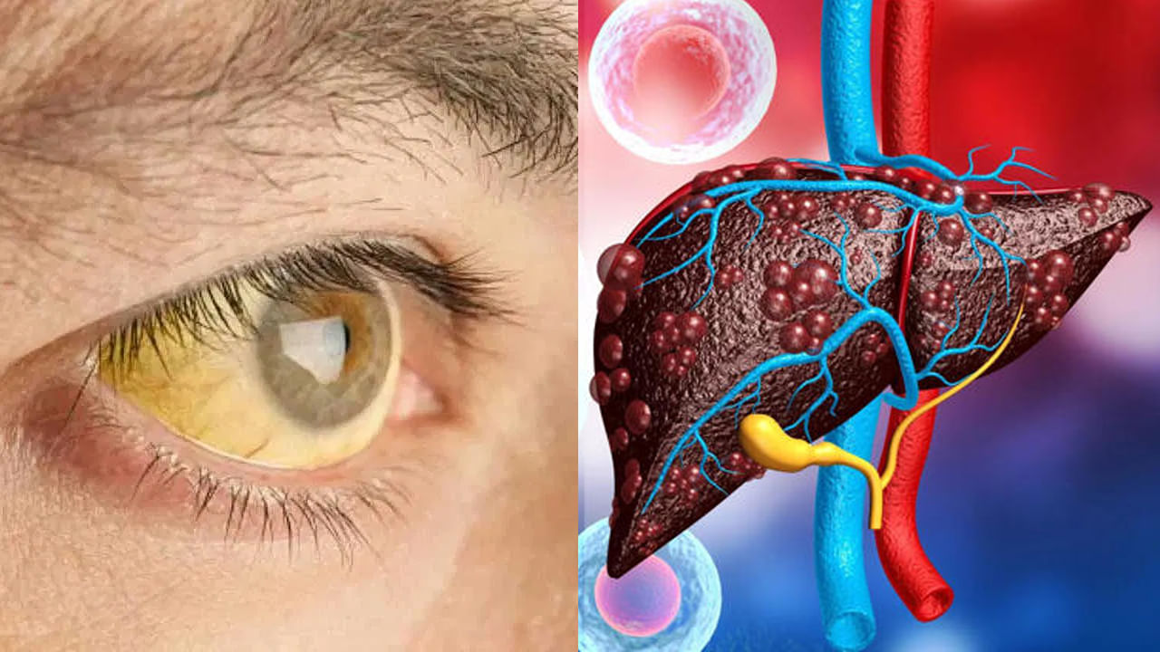 సైలెంట్ కిల్లర్.. ఈ లక్షణాలు ఉంటే కామెర్లు ఉన్నట్టే.. అసలు బిలిరుబిన్ ఎంత ఉండాలంటే..