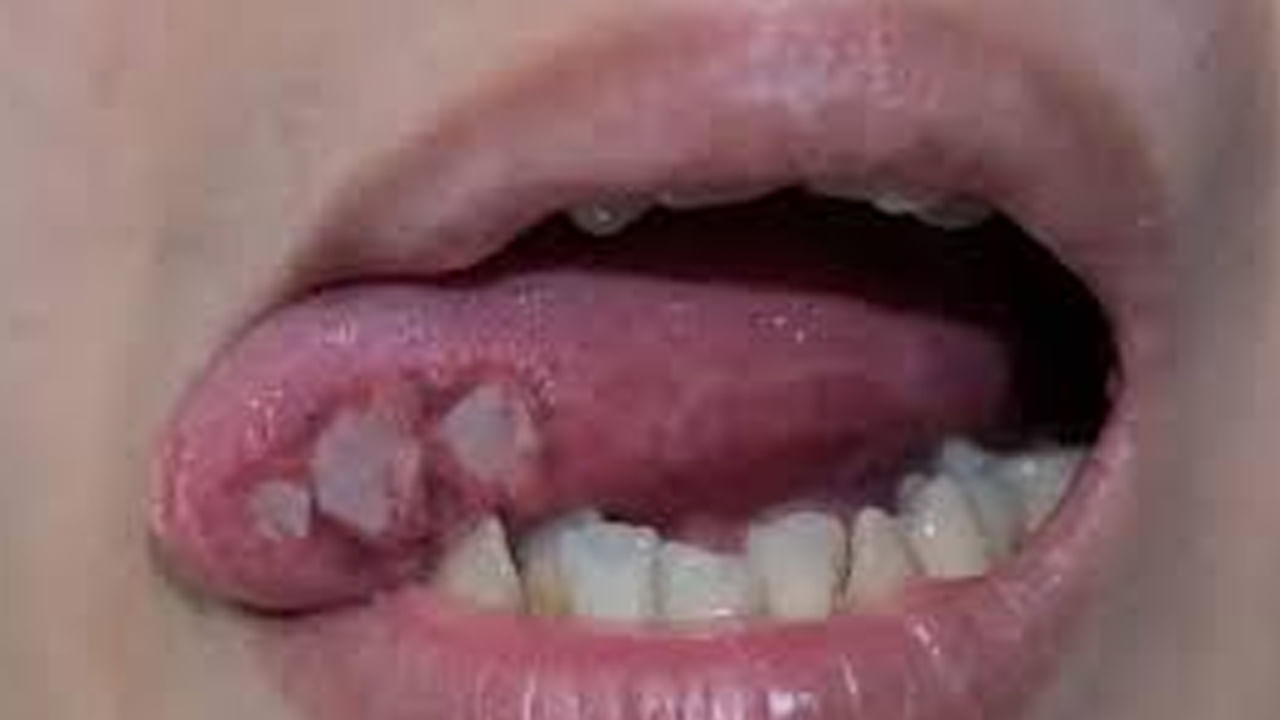 Oral Cancer: నోటి క్యాన్సర్ ప్రమాదాన్ని పెంచే అలవాట్లు ఇవే.. ఈ లక్షణాలు కనిపిస్తే నిర్లక్షం వద్దు సుమా...