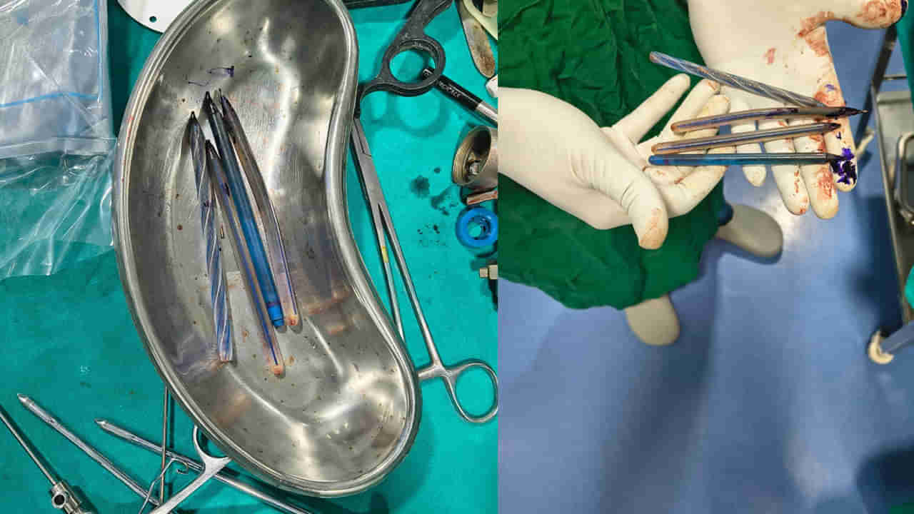 Palnadu District: మహిళకు విపరీతమైన వాంతులు - ఆస్పత్రికి రాగా టెస్టులు చేసిన డాక్టర్లు షాక్