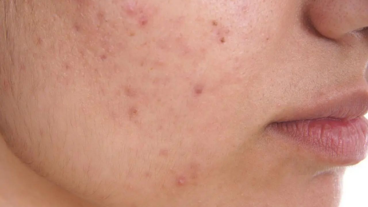 ముఖంపై మొటిమలకు కారణం బ్యూటీ సమస్య కాదంటున్నారు నిపుణులు..! మరి కారణం ఏంటి..?