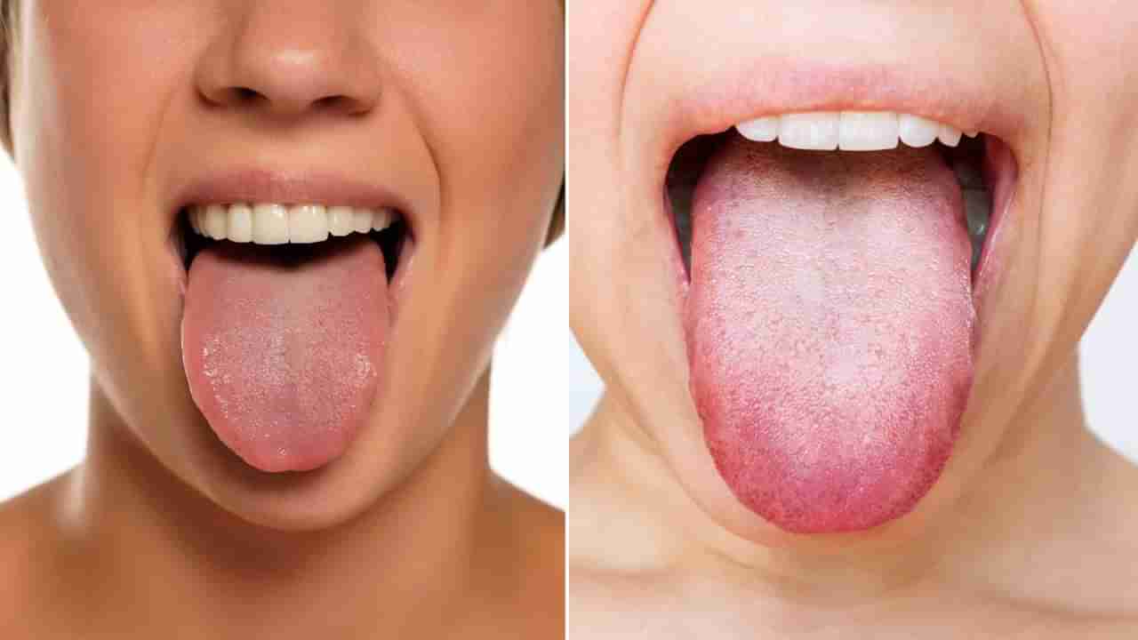 హెల్త్ అలర్ట్.. నాలుకపై తెల్లగా ఉందా..? దీనికి కారణమేంటో తెలుసా..?