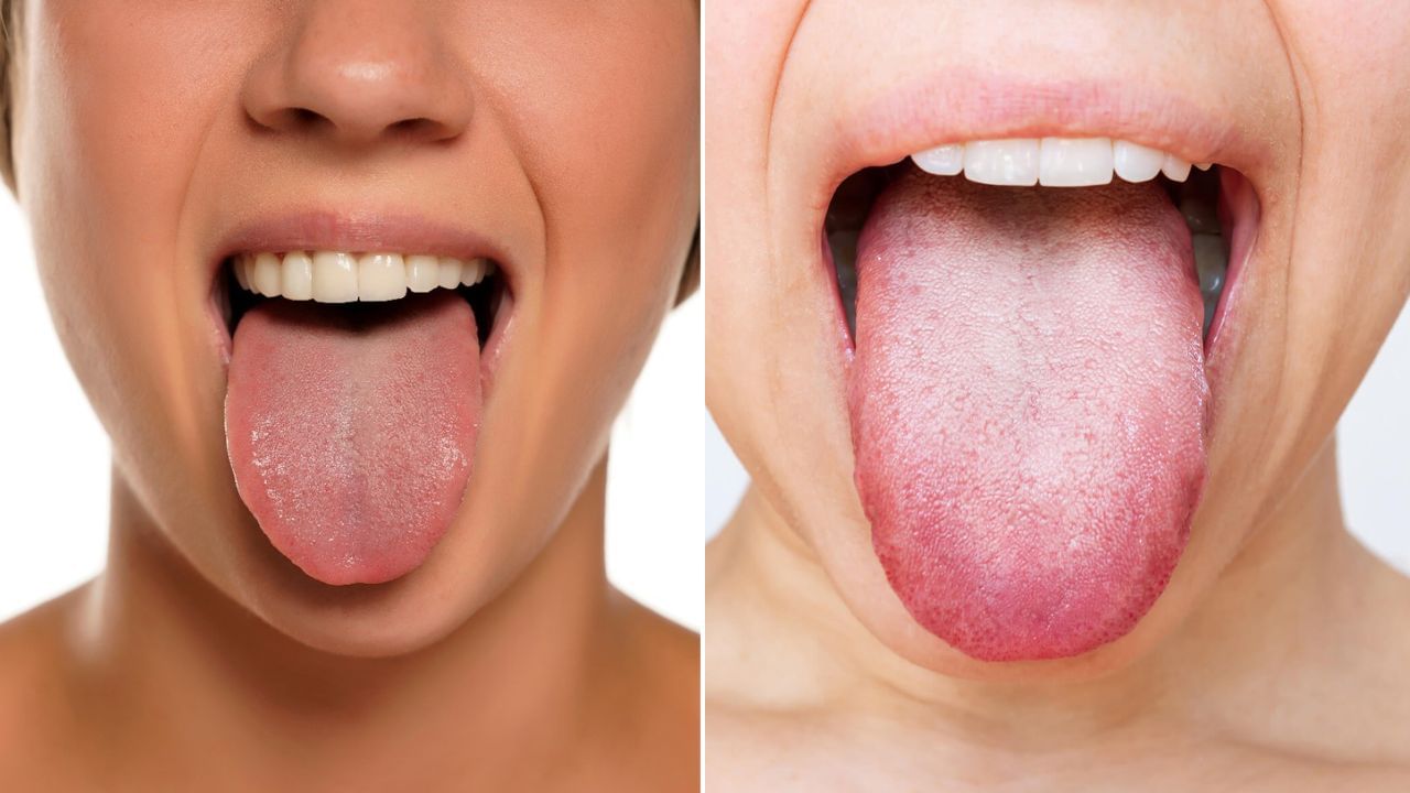 హెల్త్ అలర్ట్.. నాలుకపై తెల్లగా ఉందా..? దీనికి కారణమేంటో తెలుసా..?