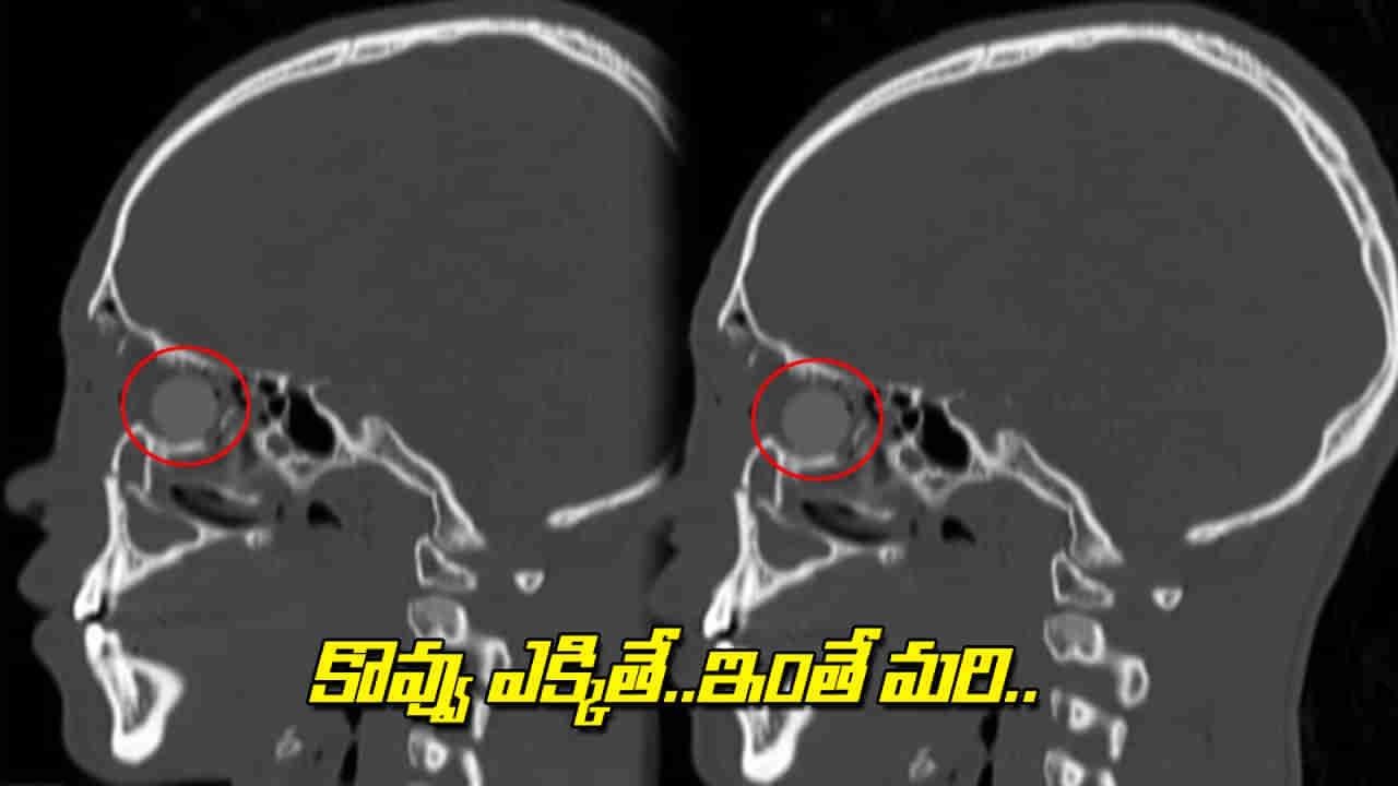 Viral: తీవ్రమైన వాపు, మసకబారిన కళ్లు.. డాక్టర్లు టెస్టులు చేయగా.. సెంటీమీటర్ పొడవైన