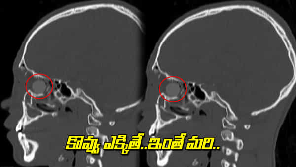 Viral: తీవ్రమైన వాపు, మసకబారిన కళ్లు.. డాక్టర్లు టెస్టులు చేయగా.. సెంటీమీటర్ పొడవైన